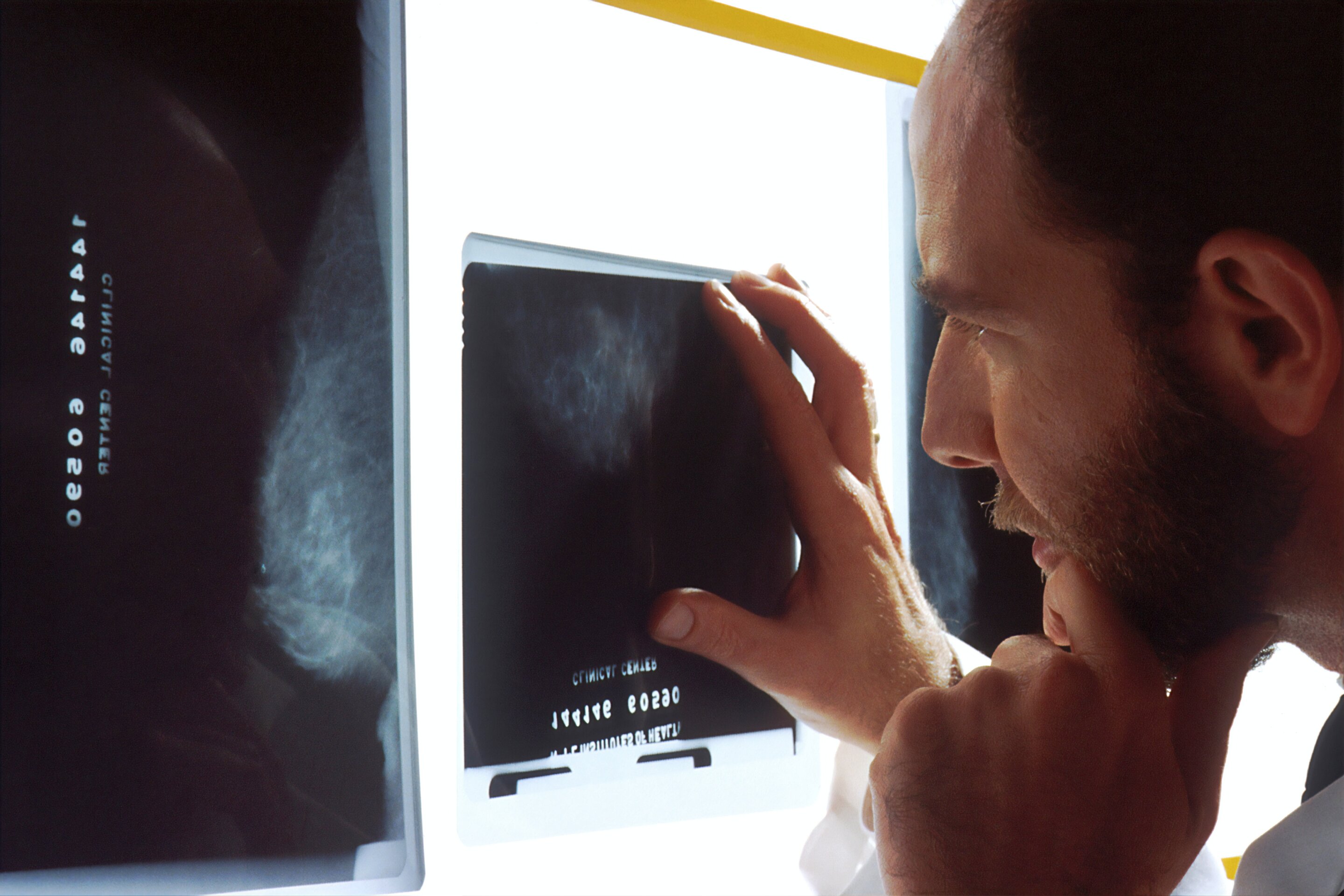 How trustworthy is AI breast cancer detection? New method gauges uncertainty for individual patients