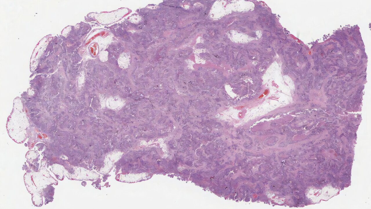 AI model detects signs of faulty DNA repair in ovarian cancer using tissue images