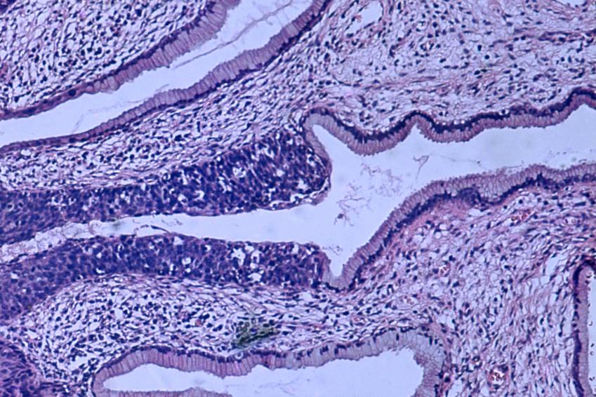 Q&A: Expert explains why women should reconsider skipping the Pap smear