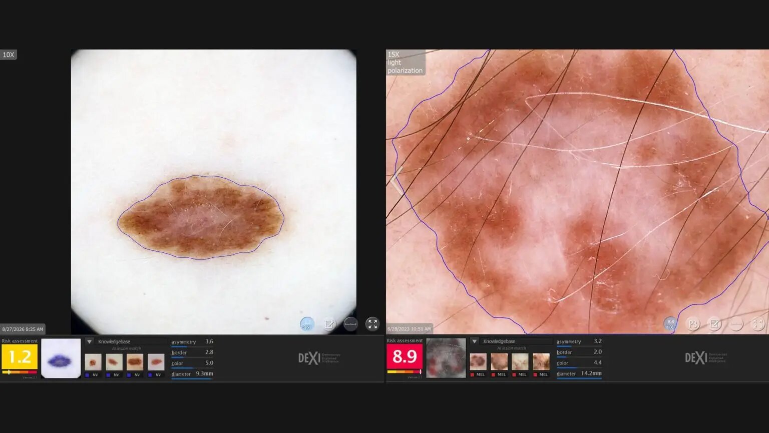AI tool may support dermatologists in assessing skin lesions for cancer risk