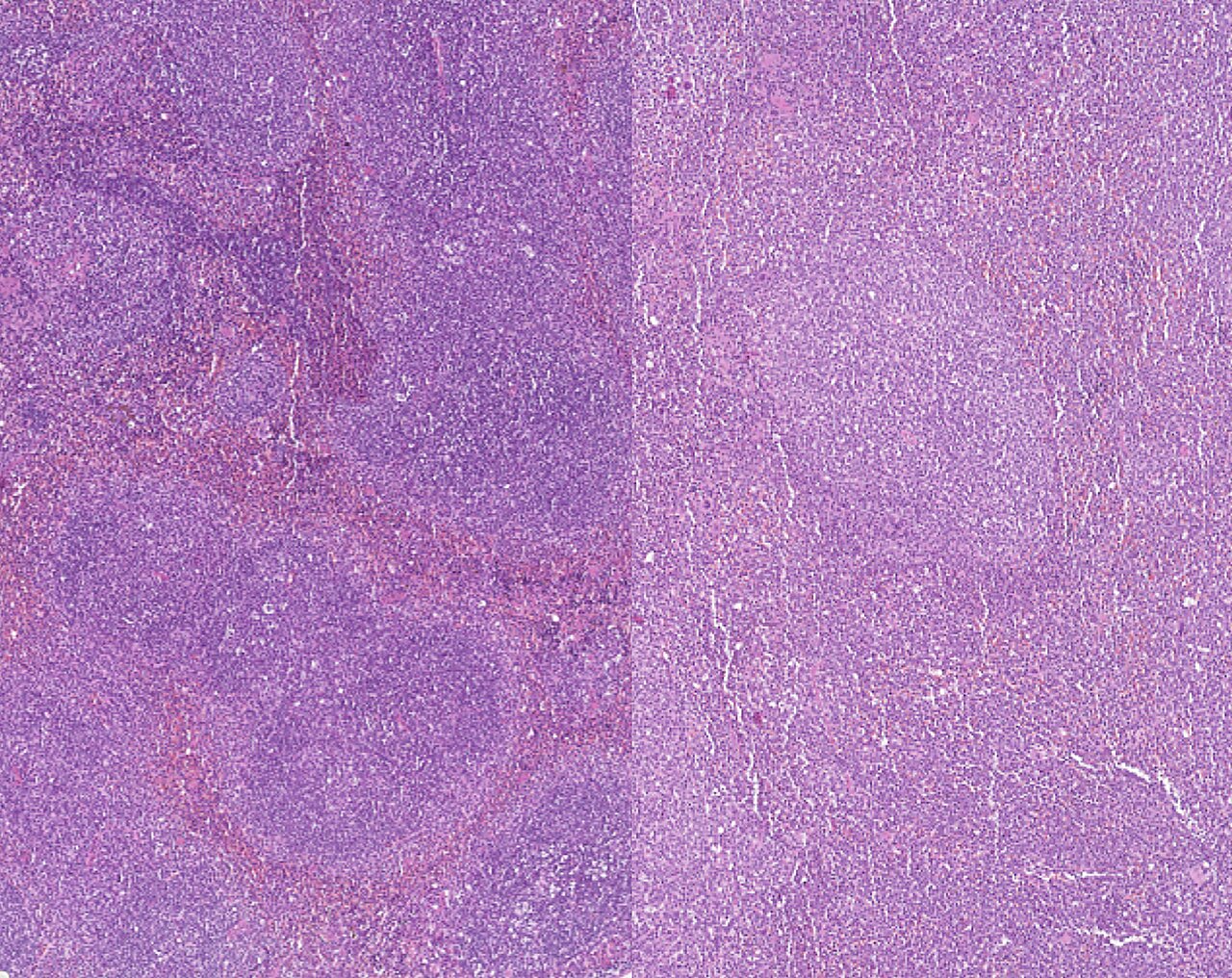 Six-gene scoring system could help predict leukemia survival