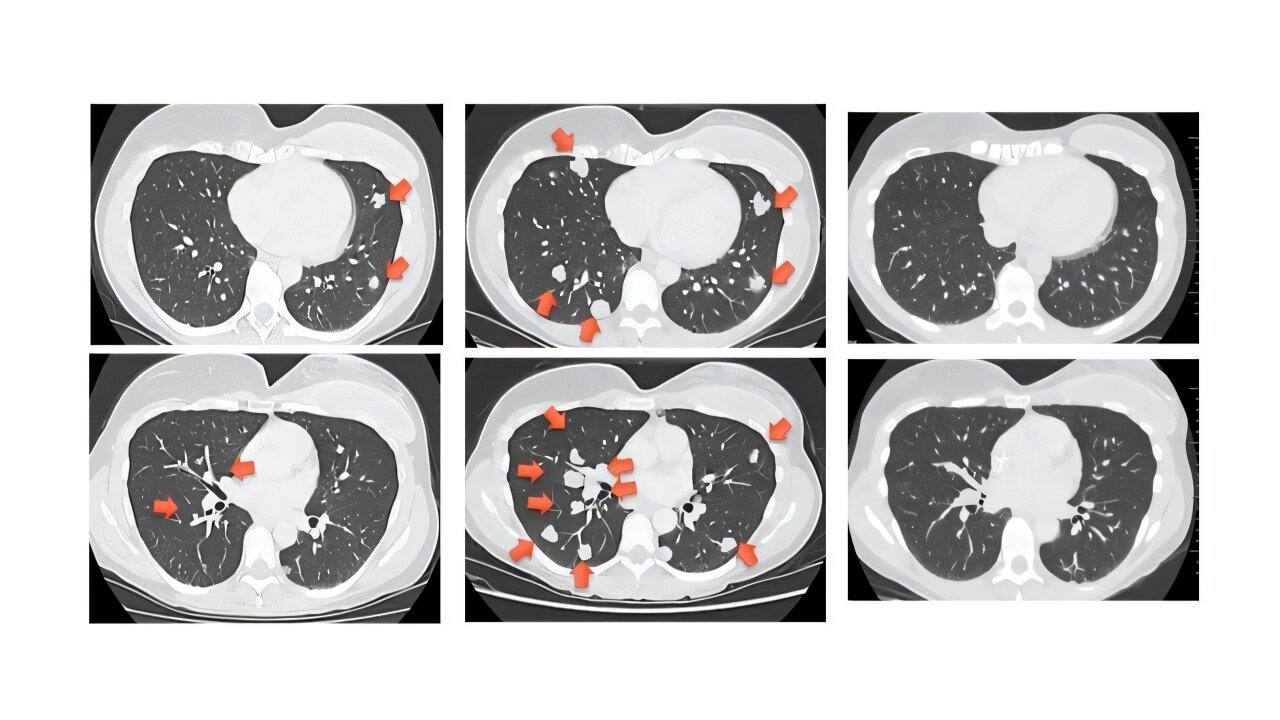 A precision T-cell therapy stalls treatment-resistant cancers in clinical trial