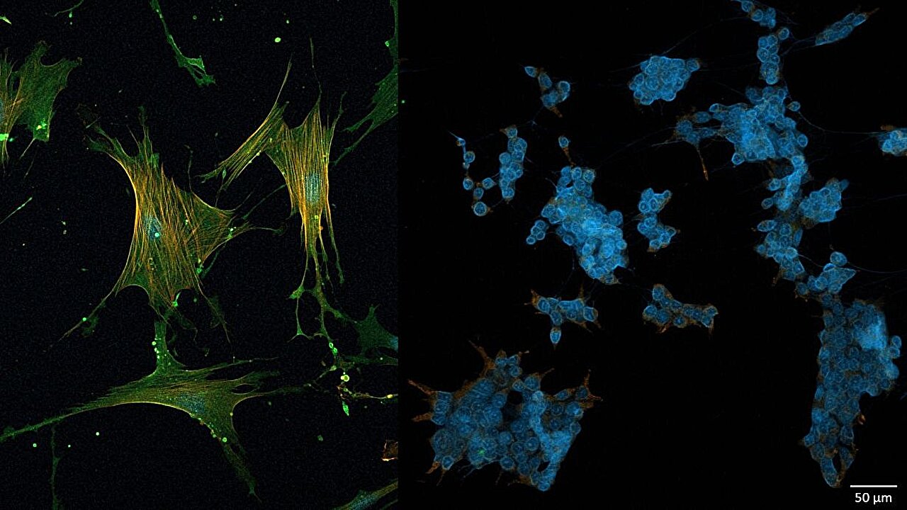 Reprogramming tumor microenvironment could improve prospects for treatment of pancreatic cancer
