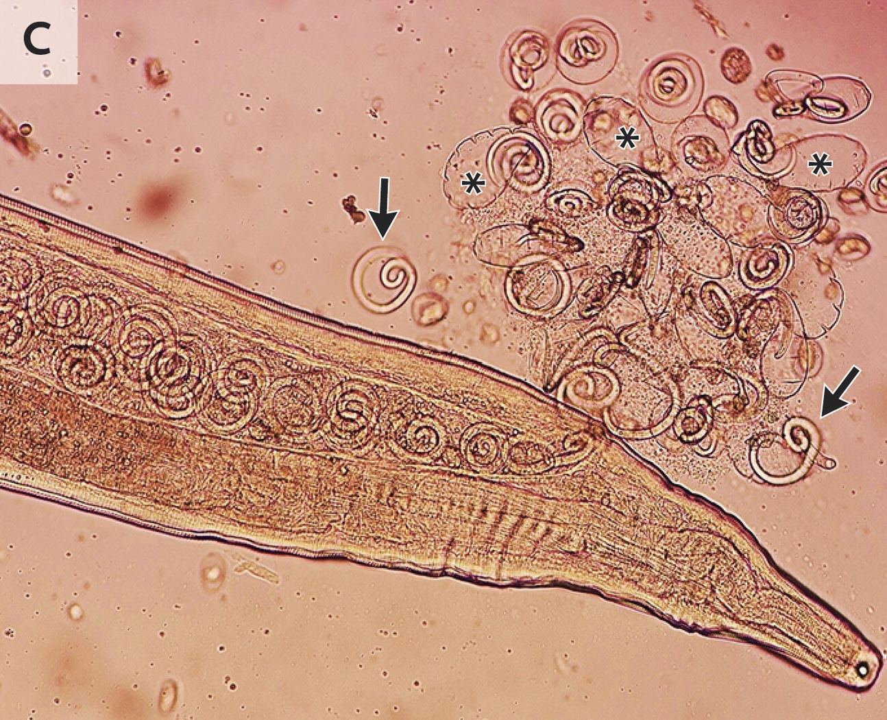 Worms mate in man's eyes, get plucked out right before larvae burst out