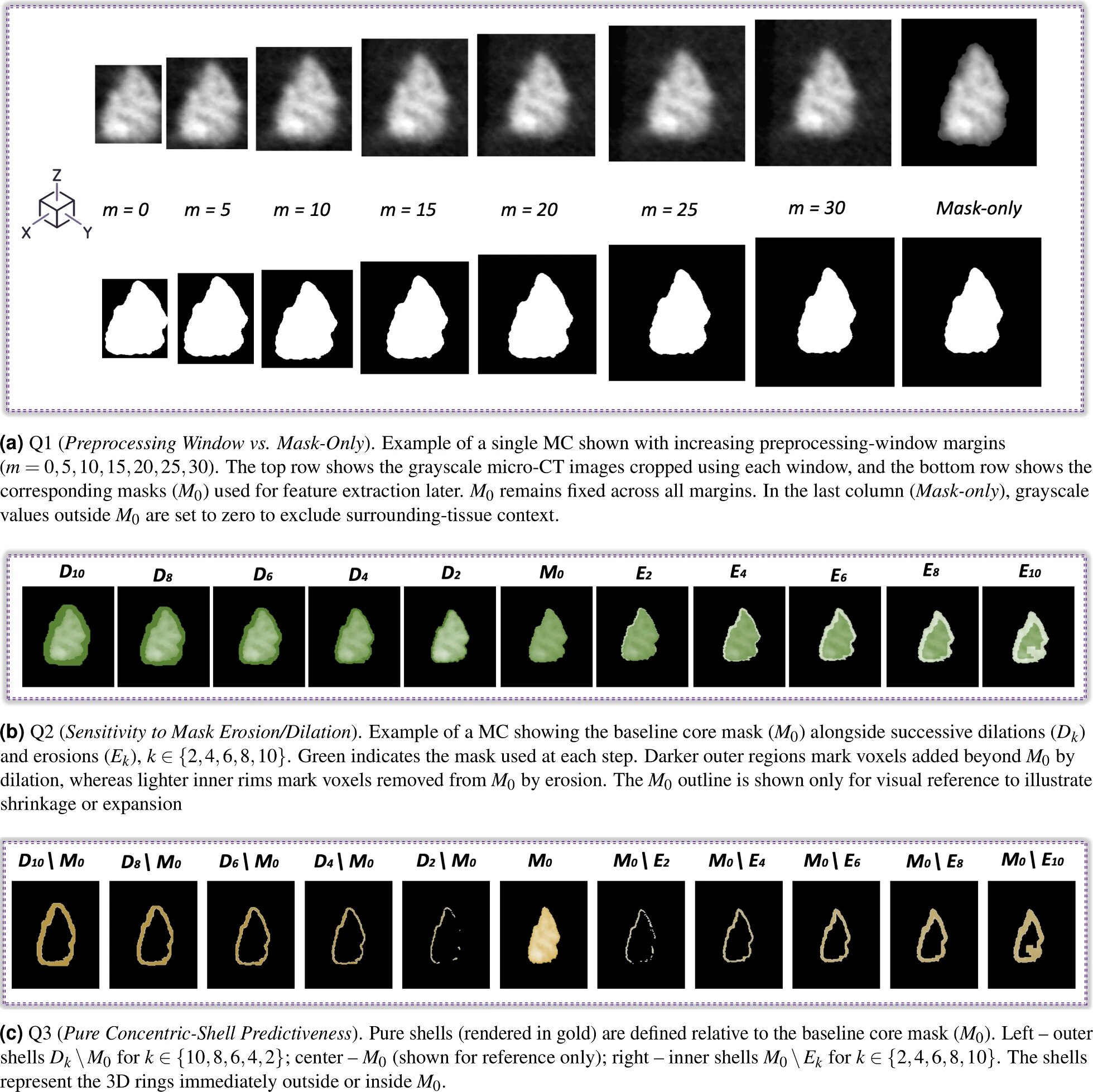 Researchers identify the tissue surrounding breast microcalcifications as a key source of diagnostic information