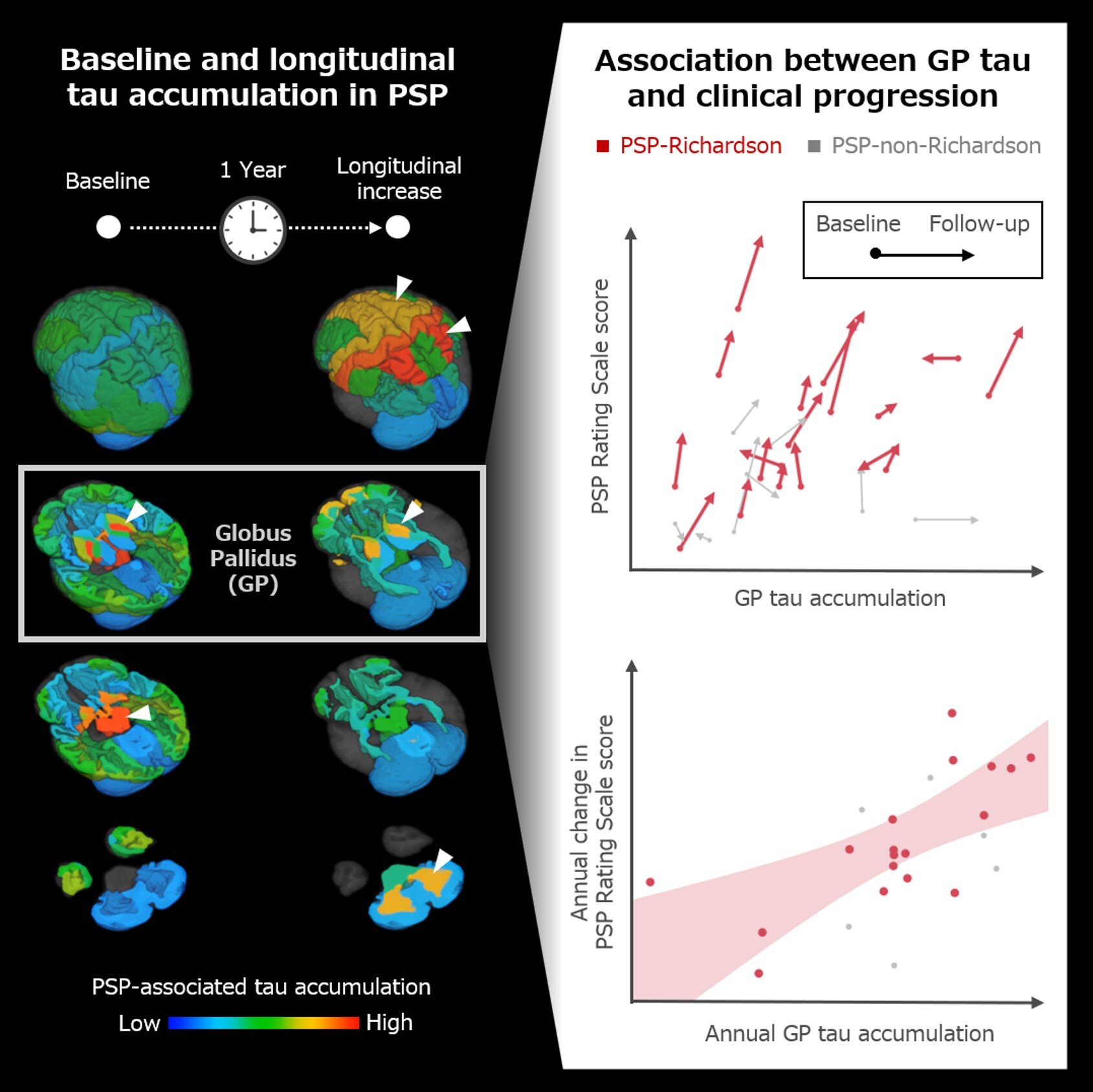 Faster brain tau buildup linked to faster progression of rare neurological disease