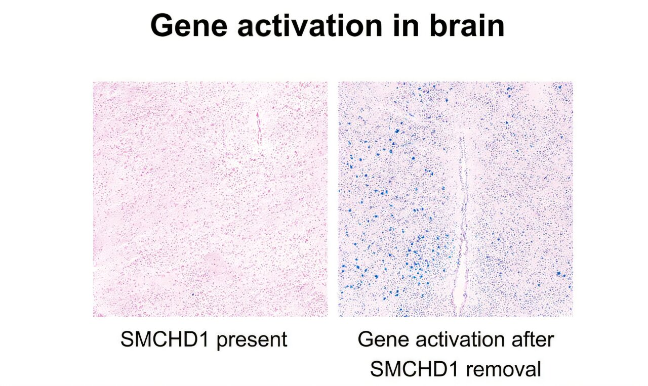 Switching on healthy silent genes reveals new way to treat Prader-Willi syndrome