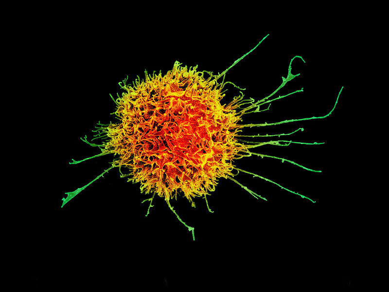 Patients Deaths and Data Shortfall Spell the End for Cell Therapy Biotech Artiva