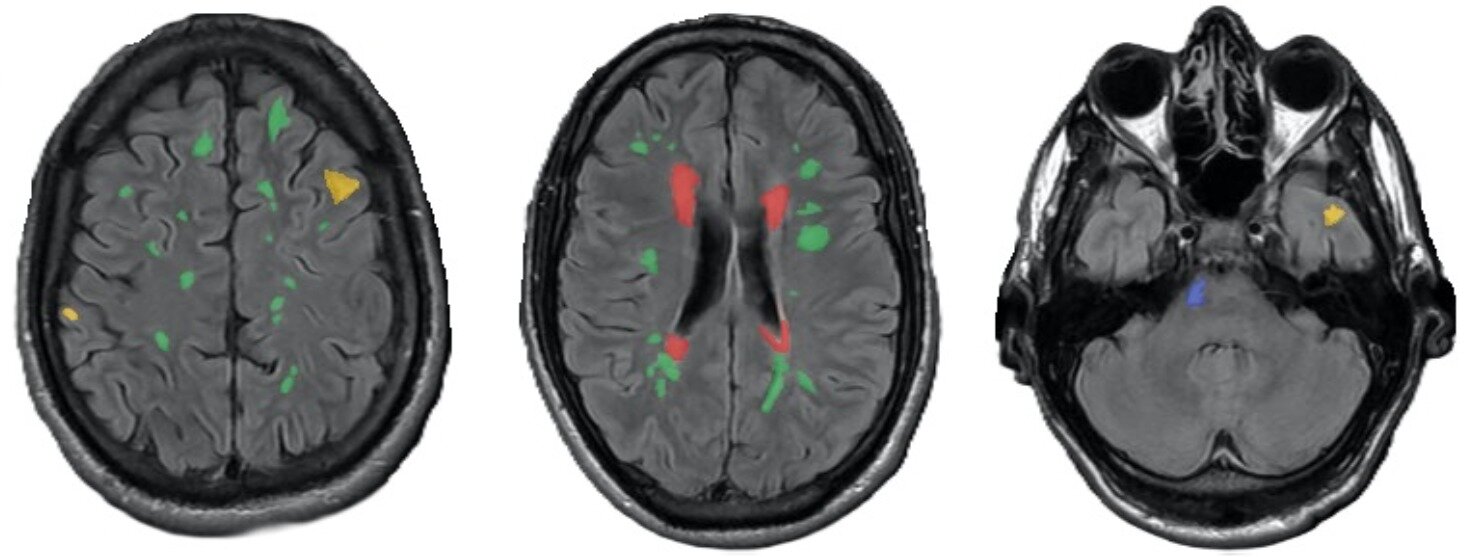 Neural network spots previously missed epilepsy signs on brain MRIs