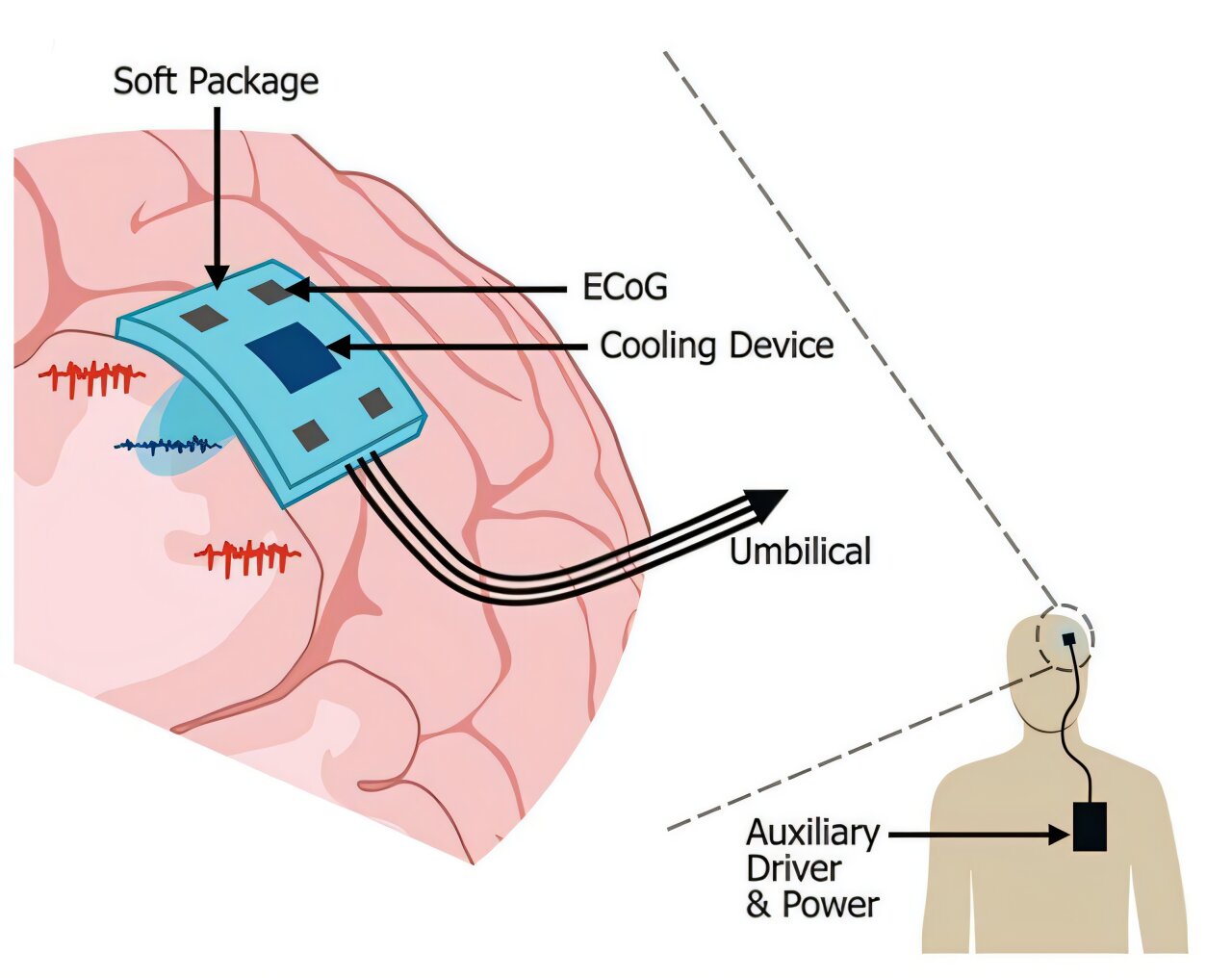 3D-printed implant prototype combines brain activity recording with targeted cooling