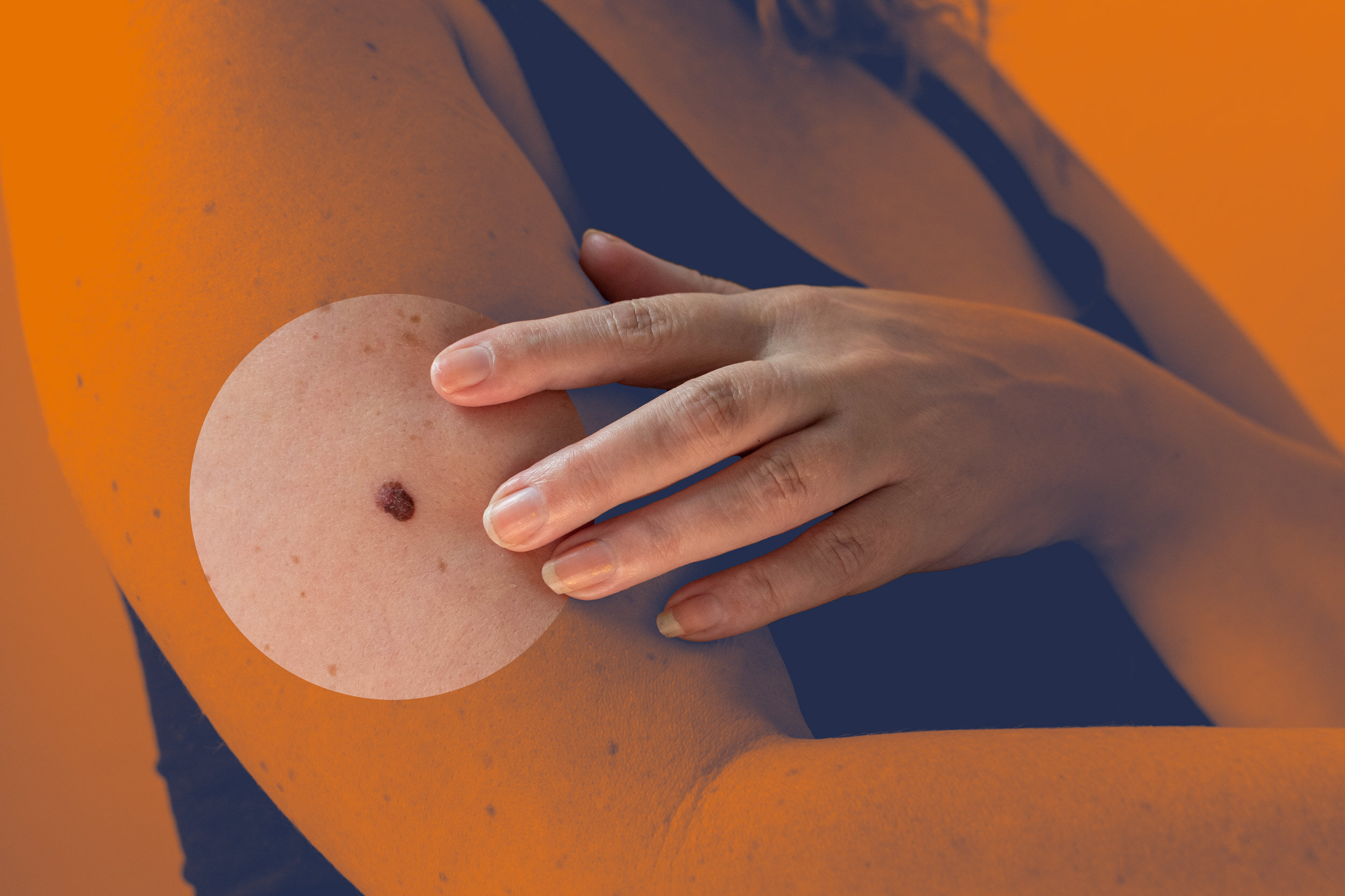 Q&A: Could a new melanoma vaccine change cancer treatment?