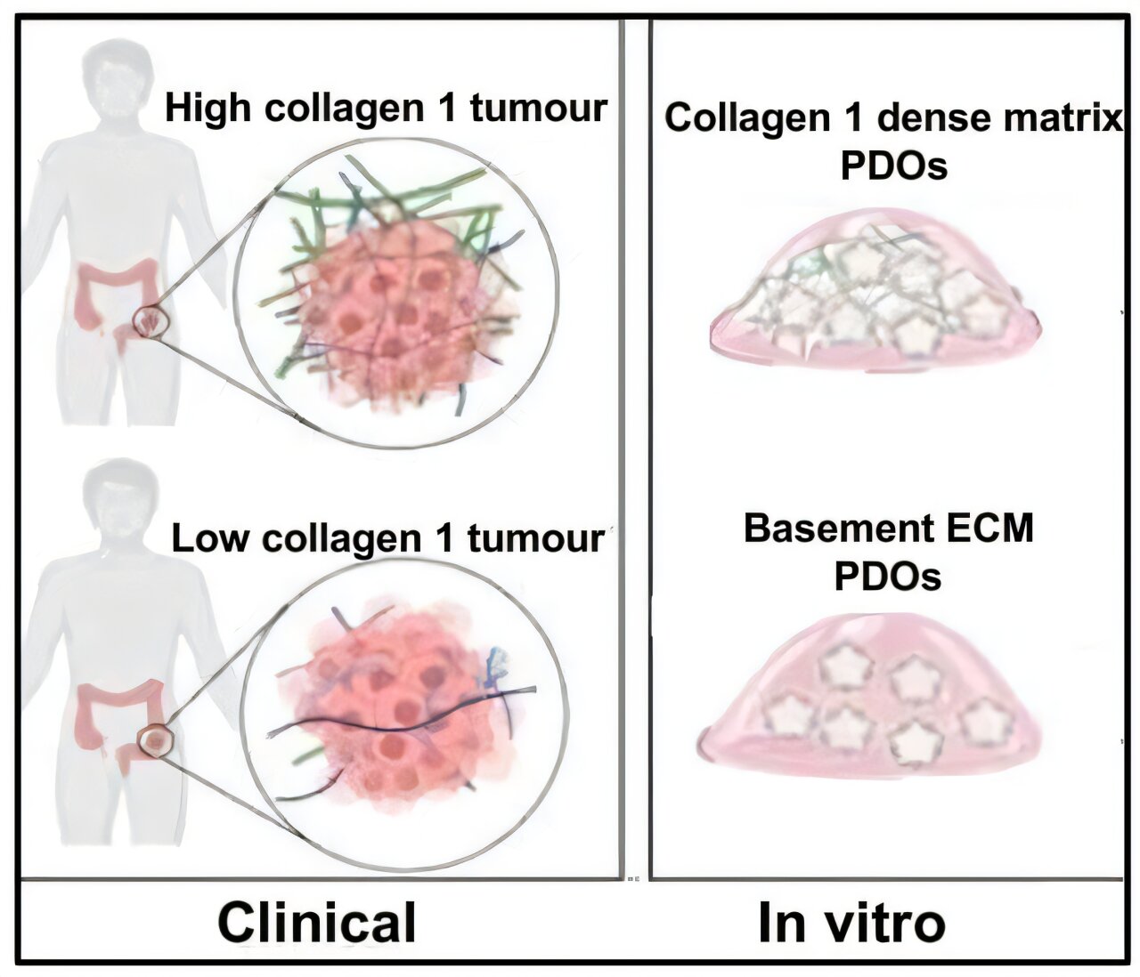 How the tumor environment influences bowel cancer cells' behavior and chemotherapy response