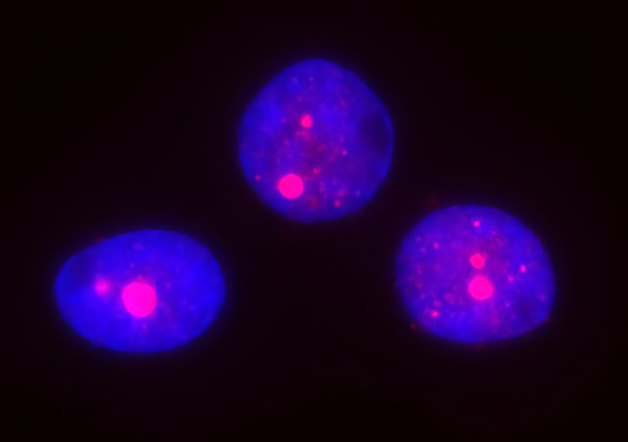 Biological mechanism underlying Huntington's disease may be more widespread in the brain than previously thought
