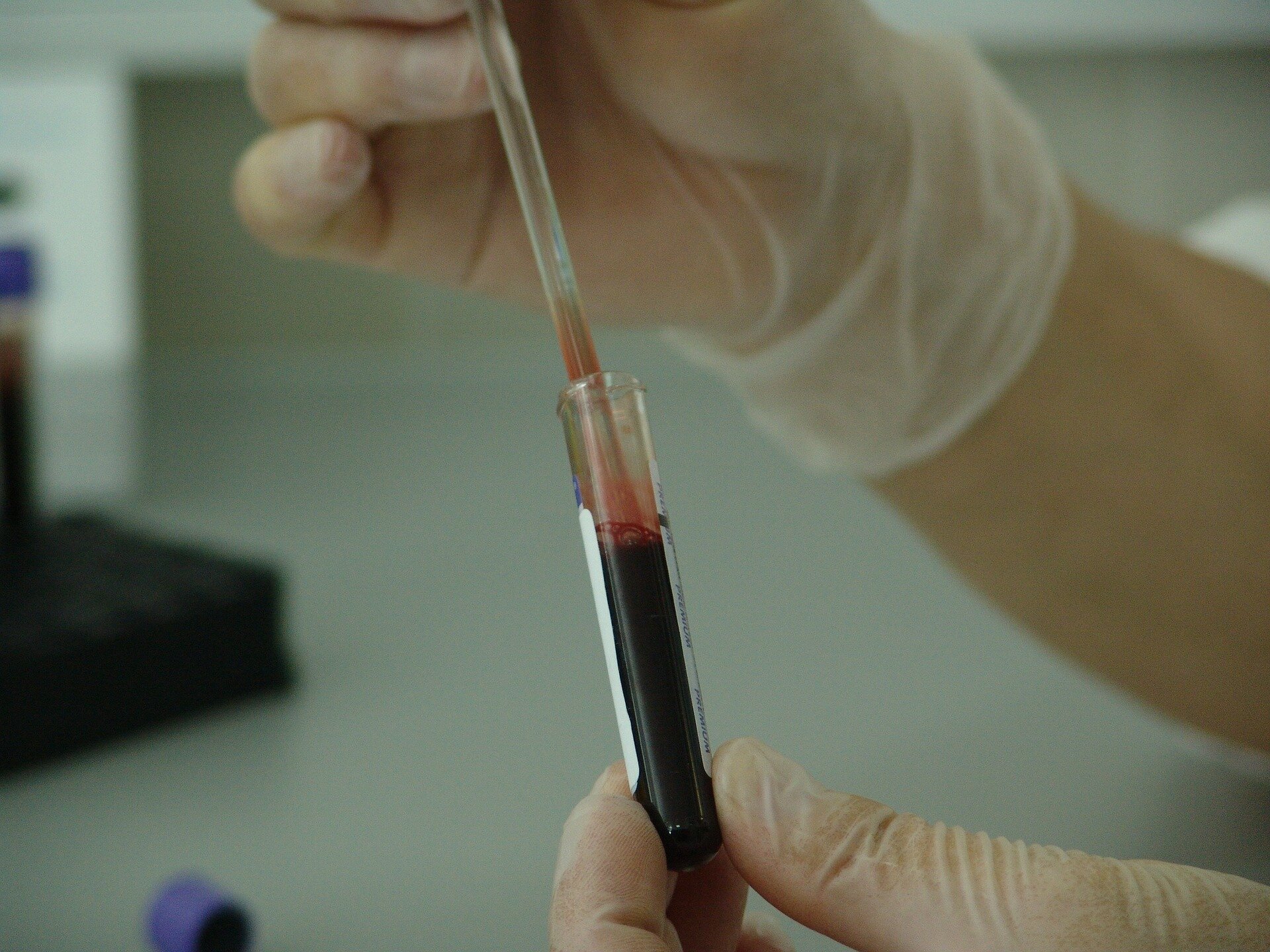 Genetic testing may help identify inherited blood disorder carrier status earlier