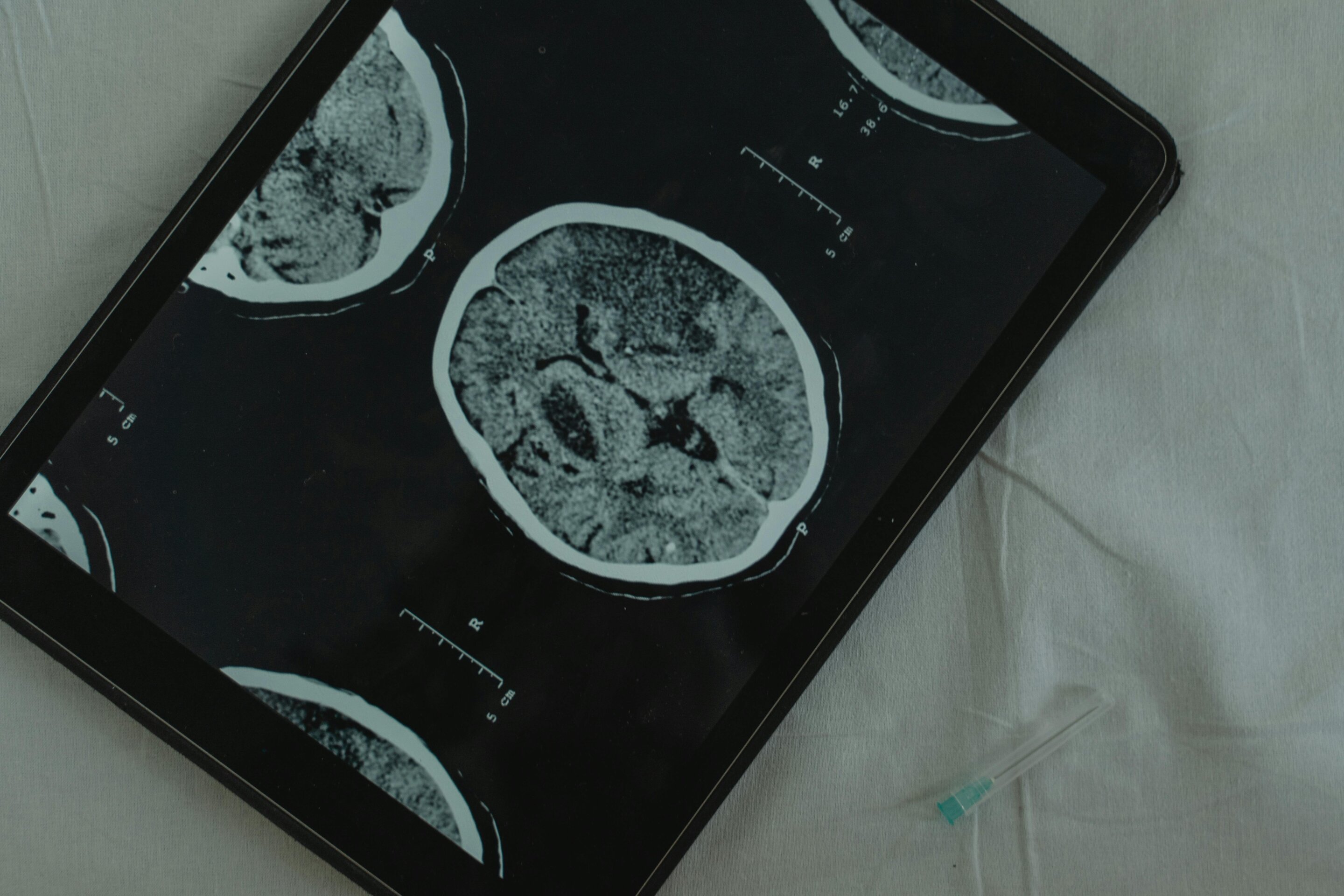 What brain scans can reveal, and why they don't always explain symptoms