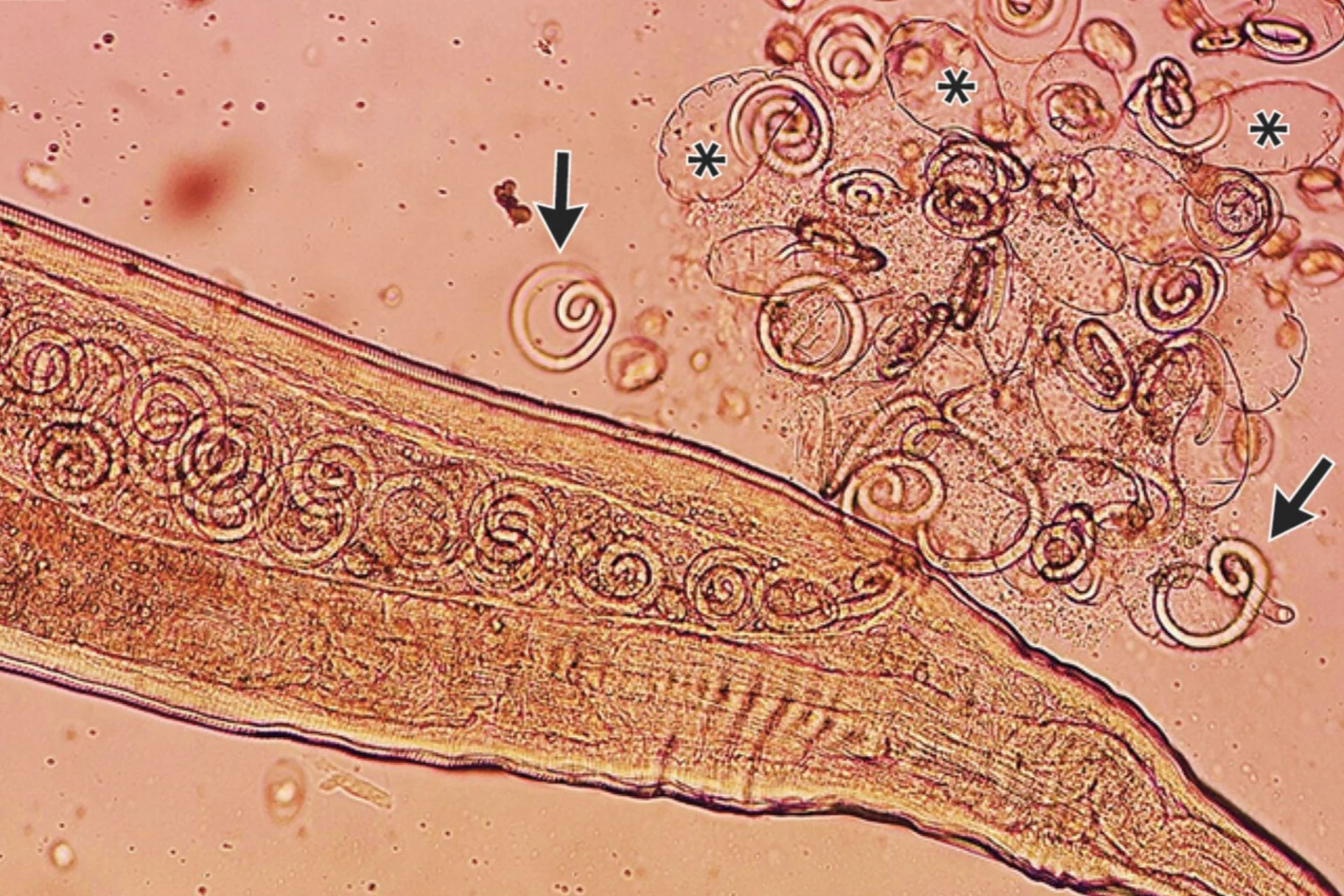 A Farmer Went in for Cataract Surgery. Doctors Found 11 Worms Wriggling in His Eyes