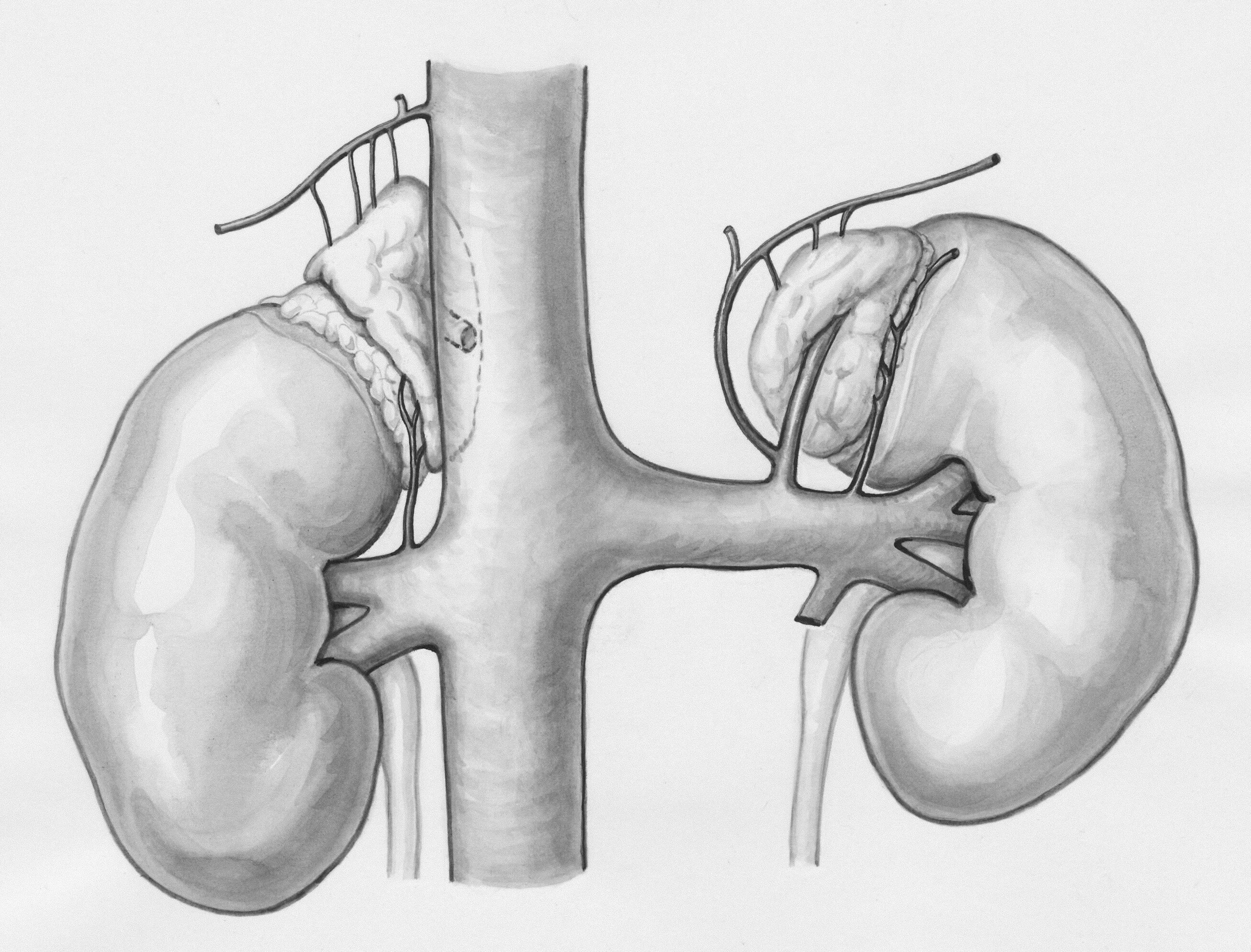 ASN: Low protein intake linked to kidney failure risk in Asian patients with CKD