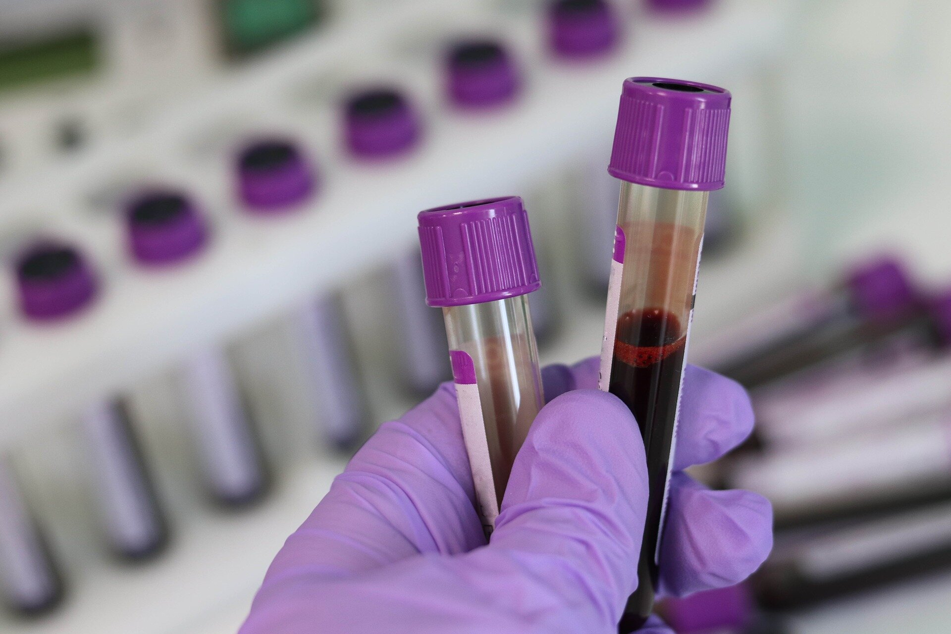 Breast cancer drug raises creatinine without necessarily signaling kidney damage, study finds
