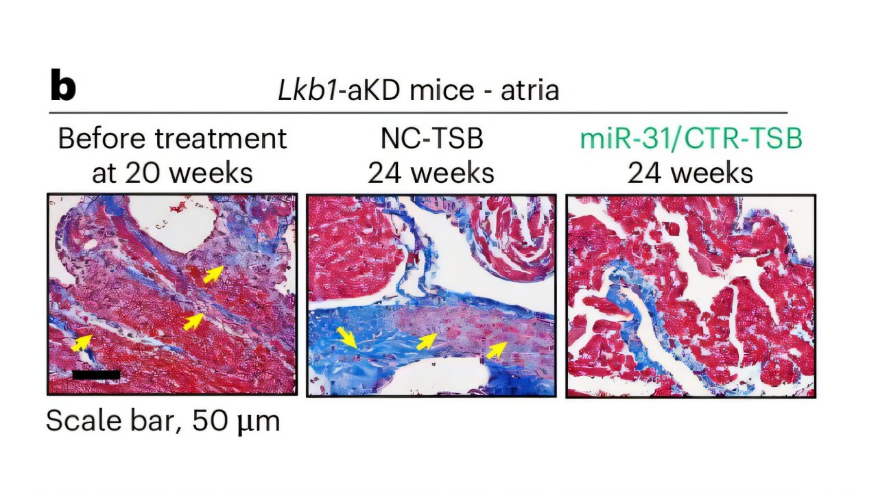 New treatment reduces heart scarring and abnormal heart rhythms, offering a possibility for future therapies