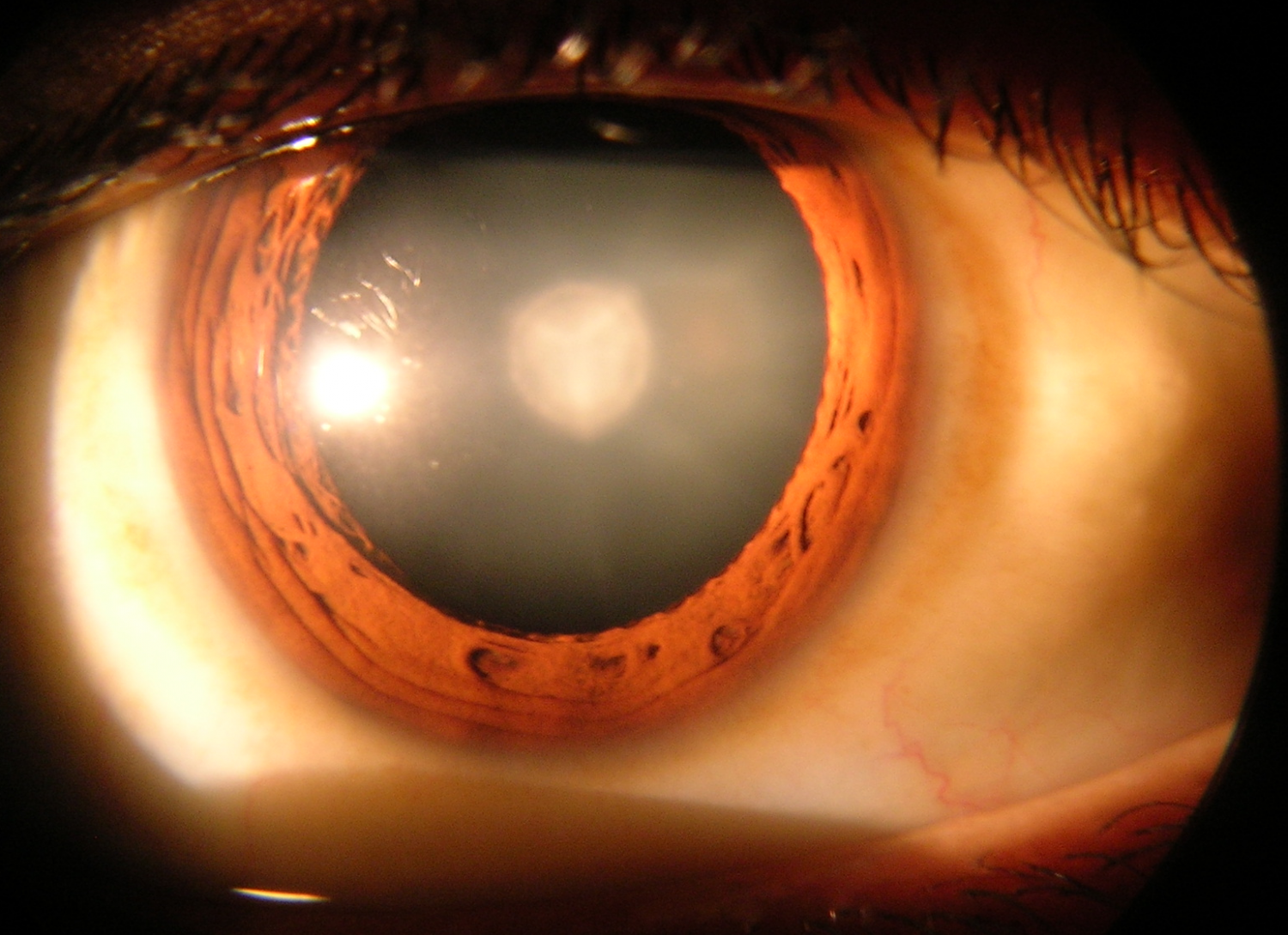 Patients with psoriasis have increased risks for cataracts, cataract surgery