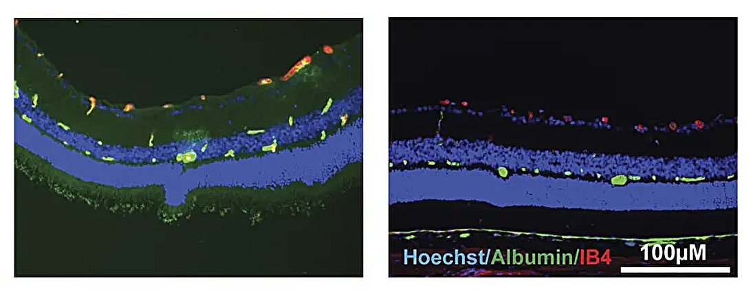 Treatment with norrin helps maintain healthy blood vessels and preserve vision in diabetic rats